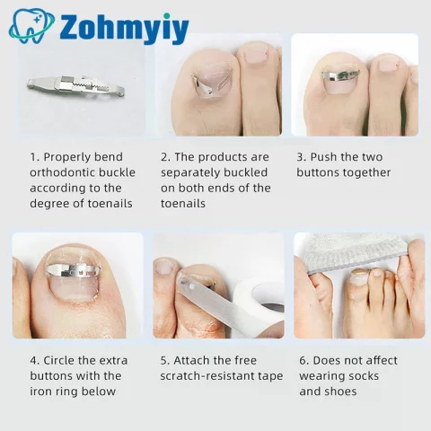 Herramientas Correctoras de Uñas Encarnadas, Tratamiento Profesional para Pedicura y Recuperación de Uñas Encarnadas, Herramienta de Cuidado y Corrección de Pies 4